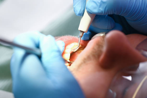 Best Emergency Treatment for Dental Infections or Abscesses in West Chatham, MA